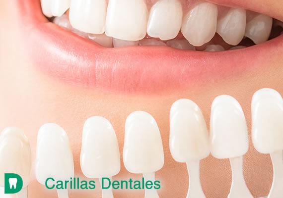 Las carillas dentales consisten en pegar unas pequeñas láminas de un grosor de entre 0,8 y 1,5 milímetros, sobre la superficie de la cara externa del diente, que camufla la pieza dental real, proporcionando un aspecto más estético a la sonrisa.