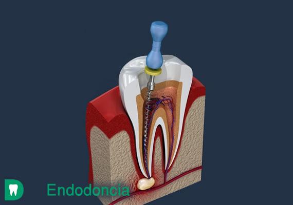 La Endodoncia es un tipo de tratamiento que consiste en la extirpación de la pulpa dental y el posterior relleno y sellado de la cavidad pulpar con un material inerte, para su posterior reconstrucción.