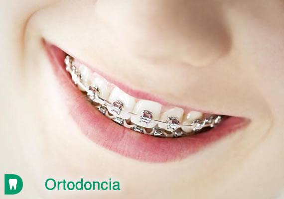 La ortodoncia es la especialidad que se encarga de todo el estudio, prevención, diagnóstico y tratamiento de las anomalías de forma, posición, relación y función de las estructuras dentomaxilofaciales.